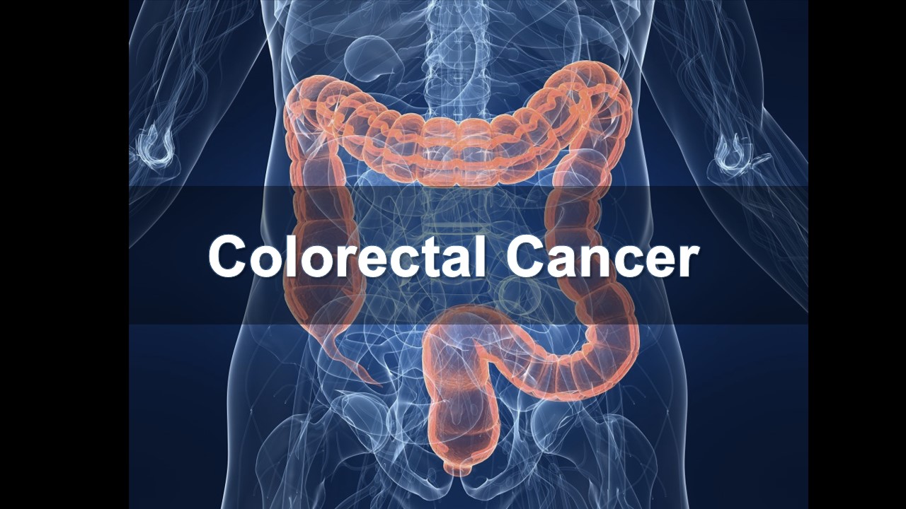 Colorectal Cancer